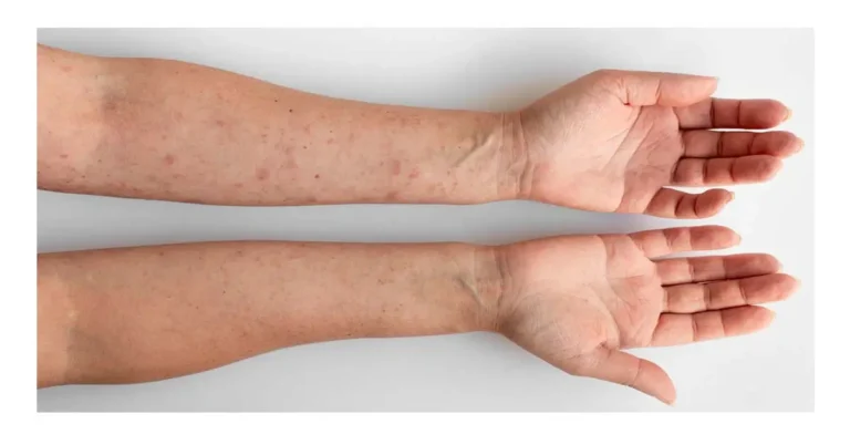 Skin Lesions