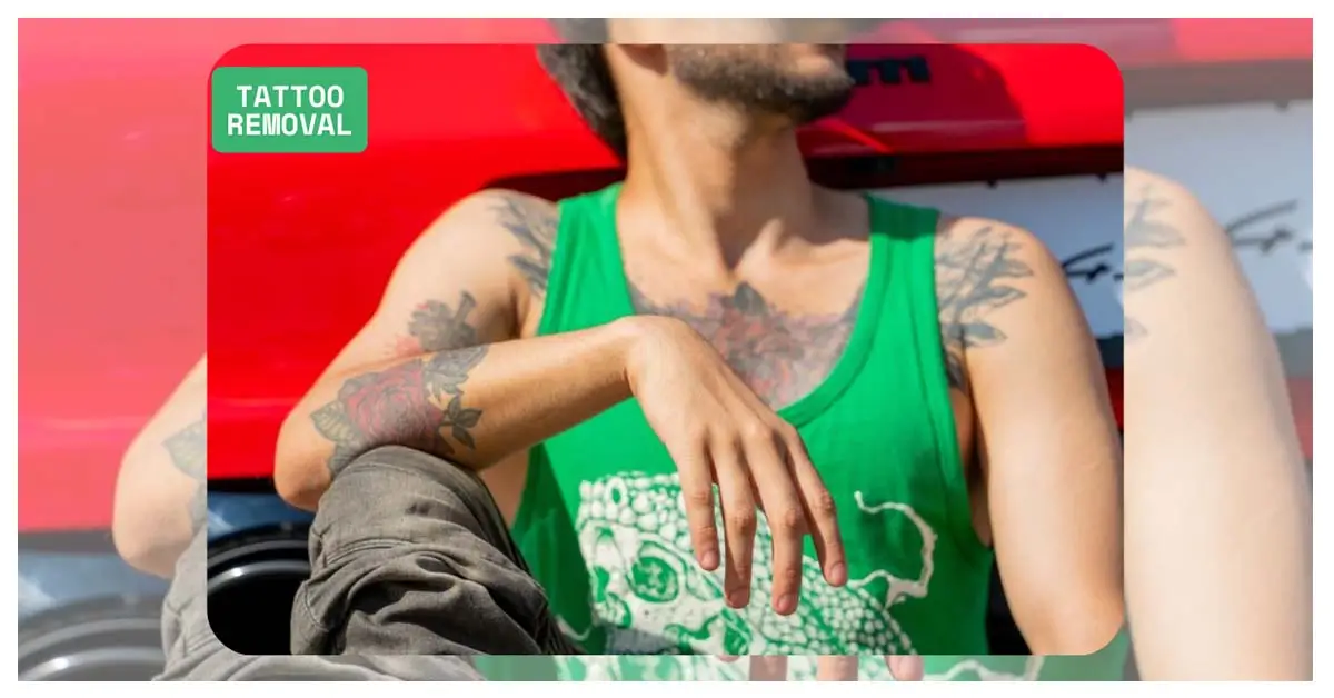 Tattoo Removal