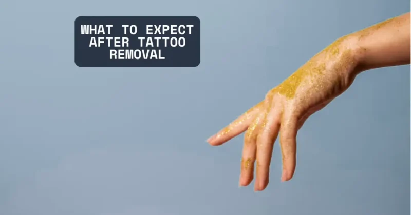 what to expect tattoo removal