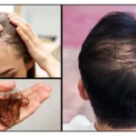 hair loss