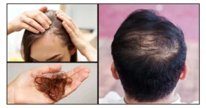 hair loss