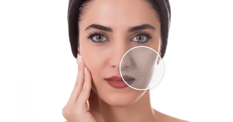 Dry Skin Causes